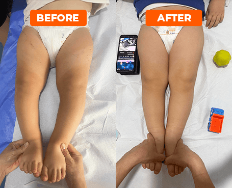 Rezultatele care vorbesc de la sine_Genu Varum